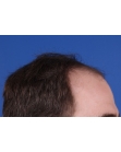 Before Hair Transplant&nbsp;Front
